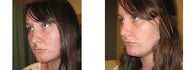 Mole Removal photos