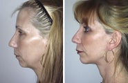 Face lift with chin implant side view
