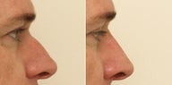 Rhinoplasty without surgery