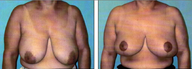 Breast lift