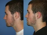Rhinoplasty