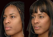 African American Rhinoplasty