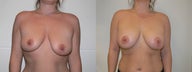 Asymmetric breast lift to correct breast asymmetry