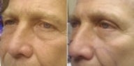 63 Year Old Man Before and After Lower Eyelid Surgery