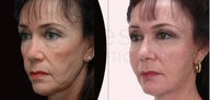 60 year old woman facial fat grafting