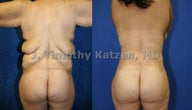 Torso Back Reduction
