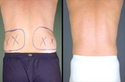 Flank Liposuction Under Local Anesthesia