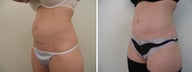 37 Year Old Mother of 3 - CoolSculpting Fat Reduction to Abdomen