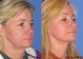 Brow Lift