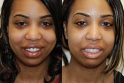 Lip Reduction Surgery.