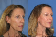 Brow Lift