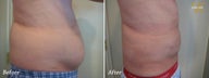 Smart Lipo