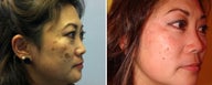 Treatment of Melasma