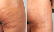 Cellulaze