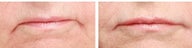 Belotero and Juvederm for lip enhancement and to reduce the lines around the mouth.