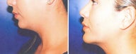 Chin Augmentation
