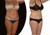 42 year old women tummy tuck after weight loss