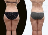 37 year old women body jet liposuction to remove fat and shaping of thighs