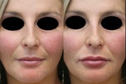 Lip Augmentation With Juvederm