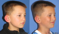Otoplasty