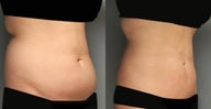 SmartLipo Liposuction