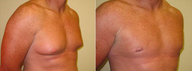 Male Breast Reduction