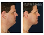 Liposuction