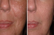 Before and After 1540 Laser Treatment of Acne Scars