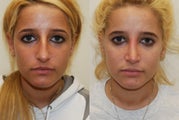 Rhinoplasty Surgery. 6 months post-op.