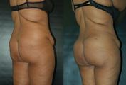 26 Year Old Female Treated for BBL