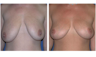 Woman Before and After Breast Lift