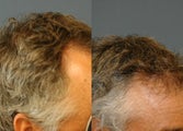 Male Hair Transplant