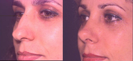 Nose
