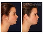 Liposuction