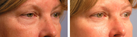 Female Blepharoplasty
