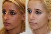 Rhinoplasty Surgery. 6 months post-op.