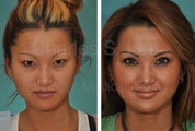Asian Eyelid Surgery
