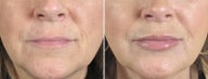 Lip Augmentation