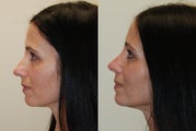 Rhinoplasty Surgery. 1 year post-op.
