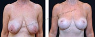 Breast Lift