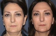 Sculptra Before and After