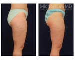 Liposuction