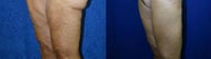 Thigh Lift after massive weight loss