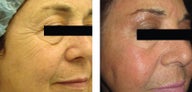 Botox