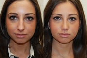 Rhinoplasty Surgery. 2 months post-op.