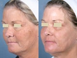 Laser Peel Treatments