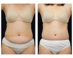 Liposuction