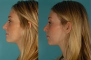 Revision Rhinoplasty