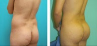 Brazilian Butt Lift Before & After