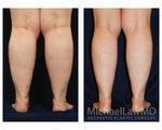 Liposuction